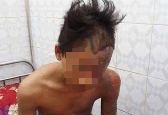 nam sinh bị sét đánh ảnh 1 nam sinh bi set danh anh 1