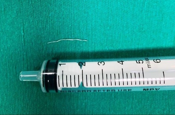 Soi inox cua mang loc chao mac trong co be gai suot 3 thang hinh anh