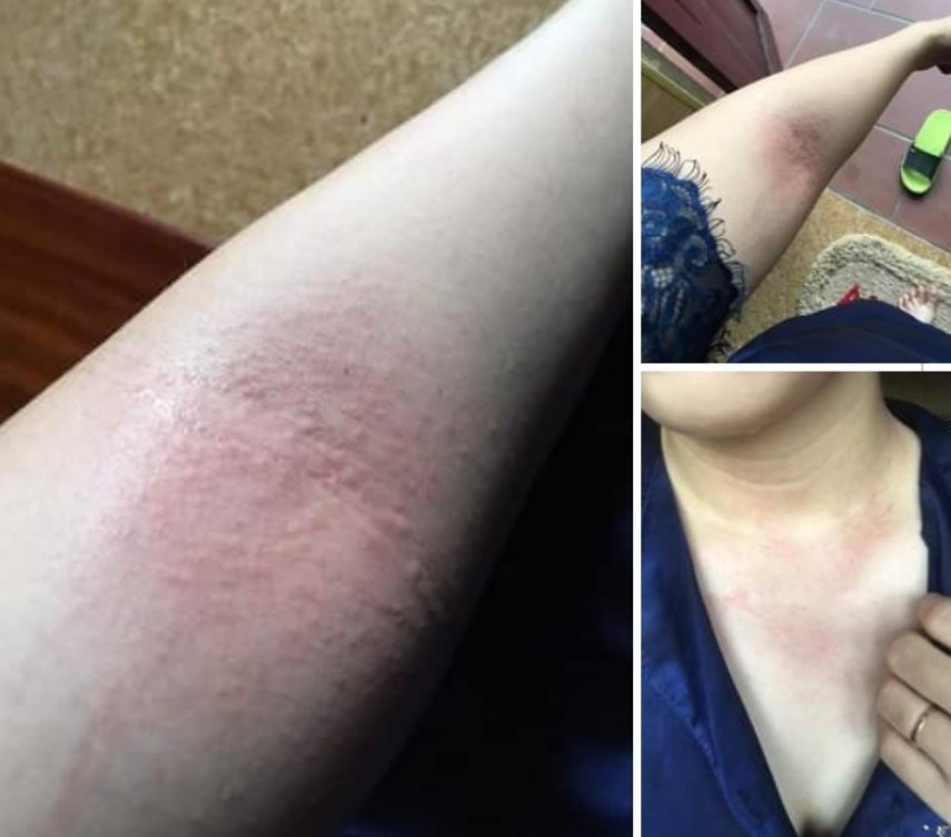 man ngua sau khi tam anh 2