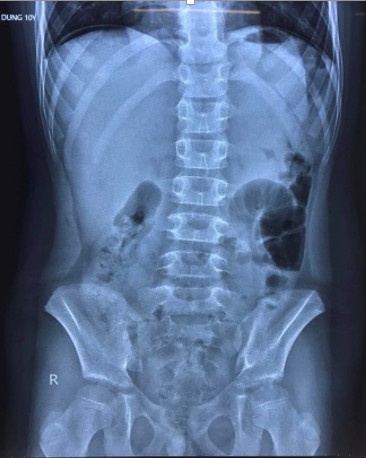 benh nhi mac covid bi thung da day anh 1