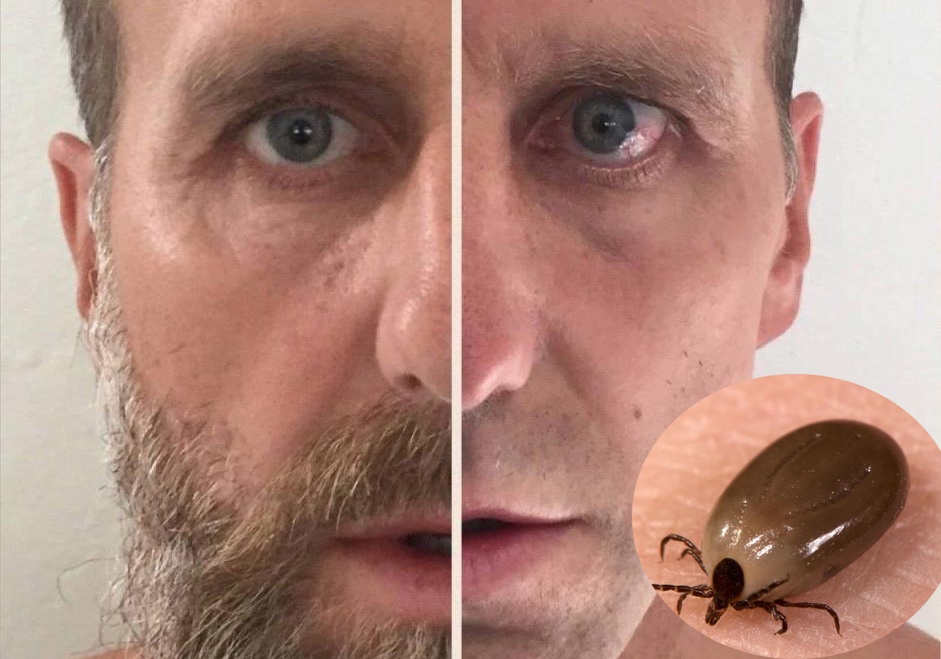 Cuu sao MU mac benh nhiem trung vi bo ve song lau ngay trong rau hinh anh