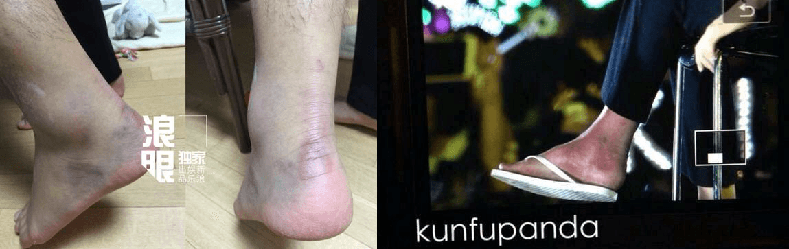 Những bức ảnh mới về chấn thương chân của Tao lan truyền trên mạng.