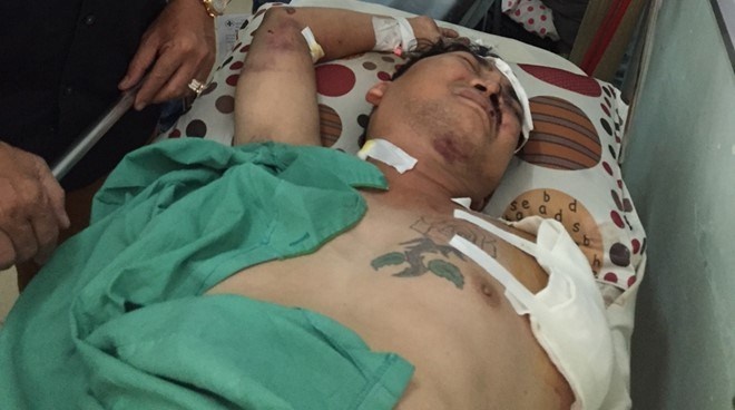 Ca si Viet bi tai nan mat mot canh tay dang hoi phuc hinh anh