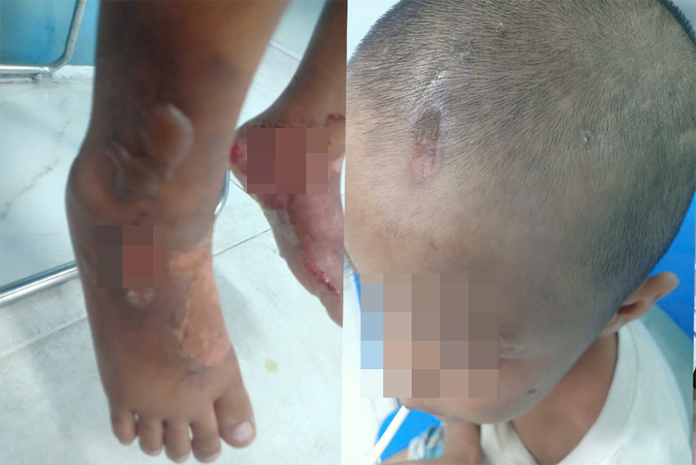 Be 6 tuoi o TP.HCM day thuong tich, nghi bi bao hanh hinh anh