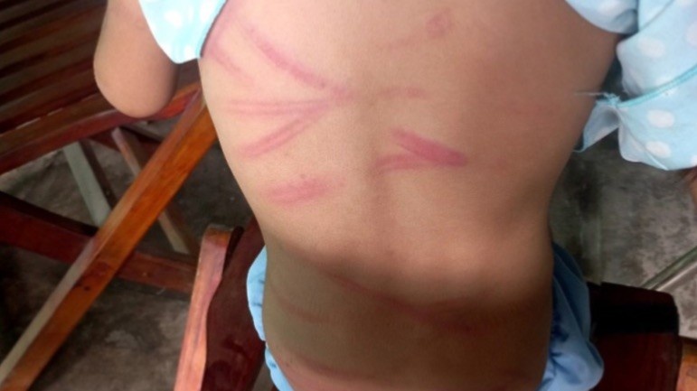 Be gai 6 tuoi bi me danh nhieu lan gay thuong tich hinh anh