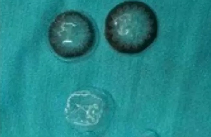 Bac si bat ngo voi 5 chiec kinh ap trong ket trong mat nguoi phu nu hinh anh