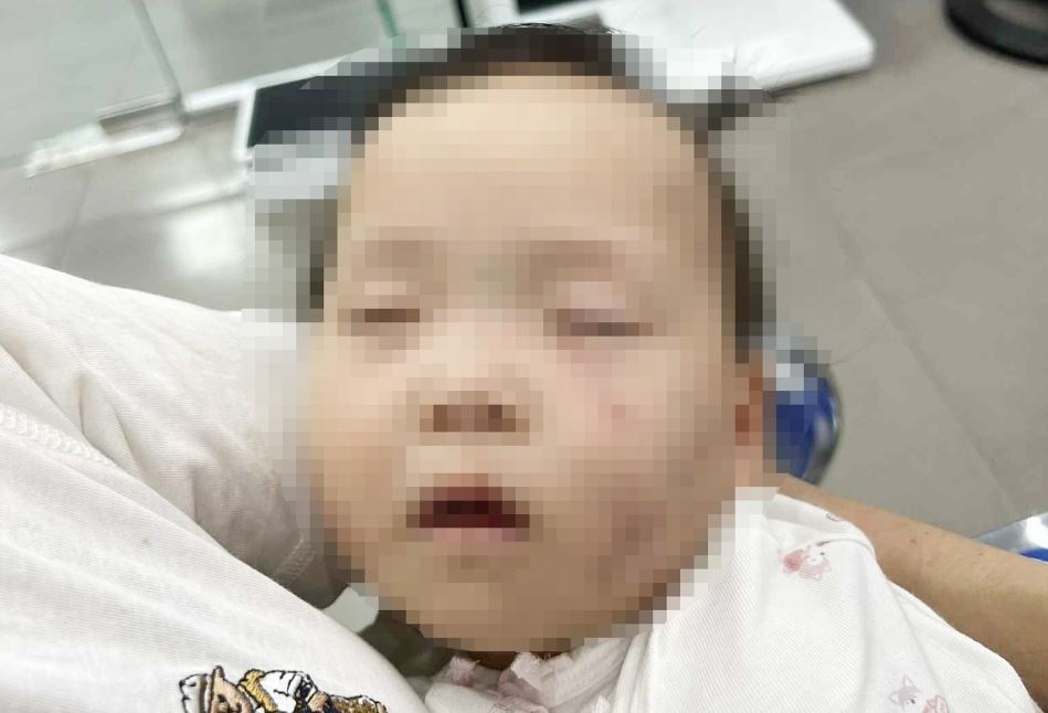 Xac minh vu be gai co nhieu vet bam tren mat o co so mam non hinh anh