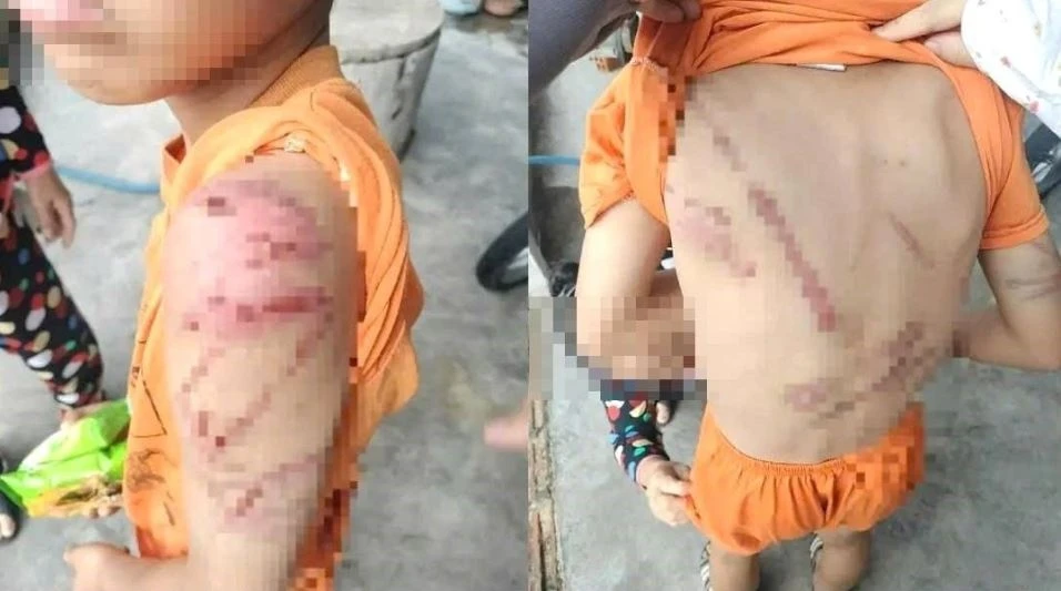 Cong an vao cuoc vu be trai 10 tuoi chi chit vet thuong hinh anh