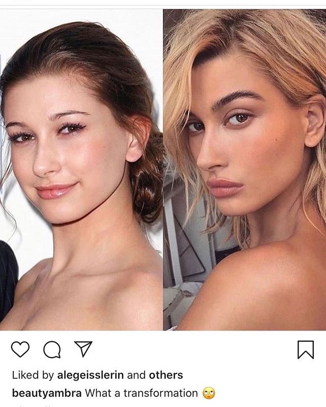 Hailey Bieber phau thuat tham my anh 1