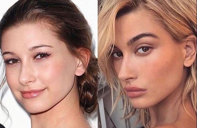 Vo Justin Bieber phu nhan phau thuat tham my hinh anh