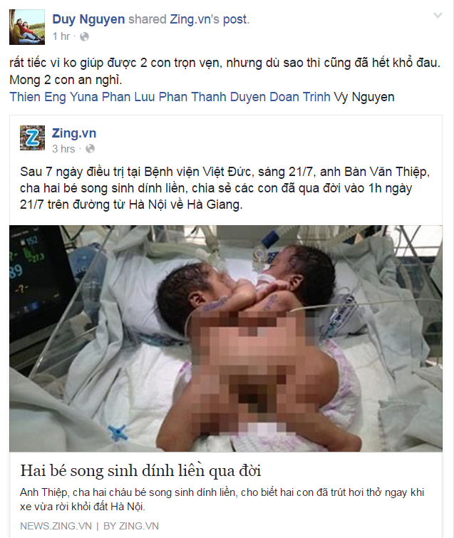 Hai bé song sinh dính liền ảnh 1 Hai be song sinh dinh lien anh 1