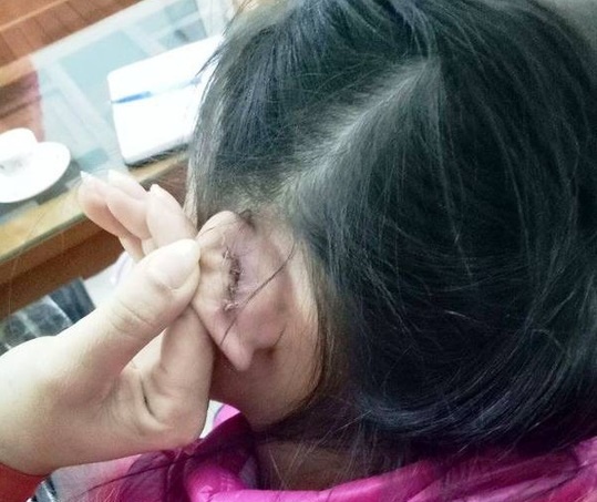 Hoc sinh bi rach tai khau 4 mui, hieu truong noi 'nghe phong thanh' hinh anh