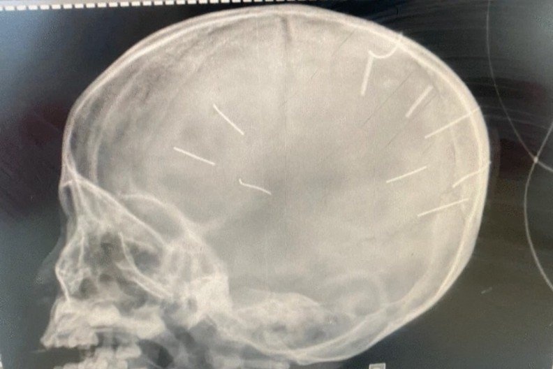 Ha Noi yeu cau cong an bao cao vu be 3 tuoi bi dong dinh vao dau hinh anh