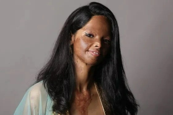 An Do dau dau voi nan tat axit hinh anh