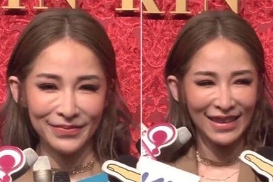 Am anh voi botox, filler hinh anh