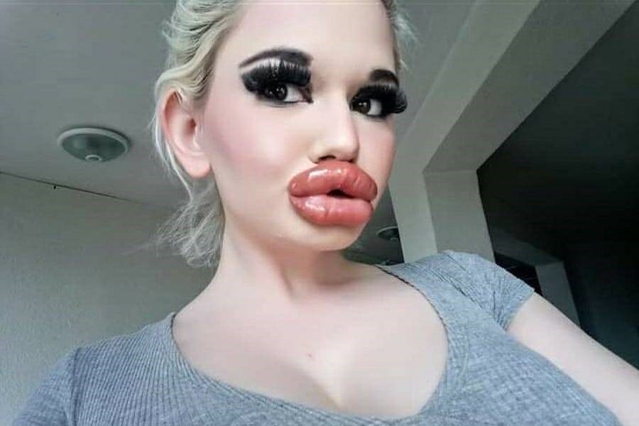 Du nguy hiem den tinh mang, co gai van tiem filler moi 32 lan hinh anh