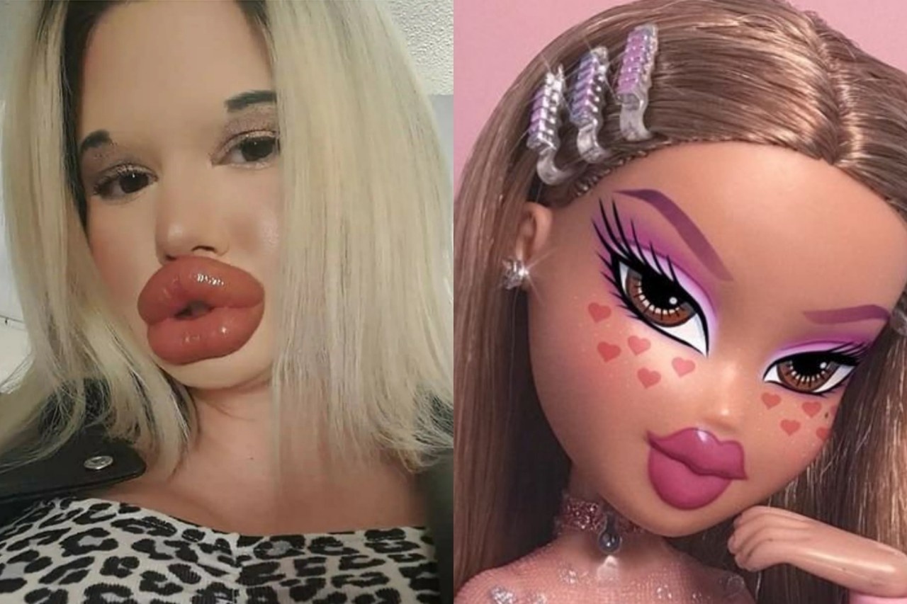 nghien tiem filler moi anh 1