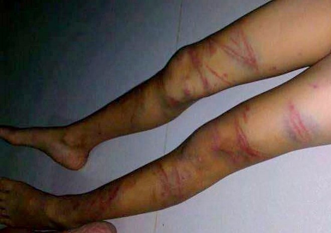 Be gai 8 tuoi bi bo danh nhap vien anh 1