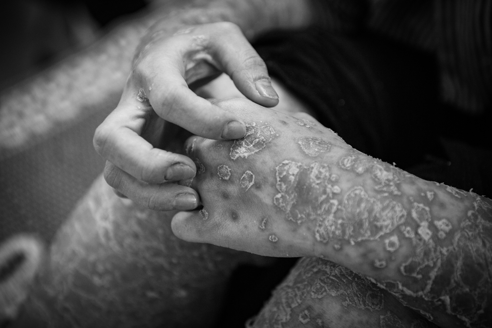 Bệnh nhân vảy nến ảnh 16 Benh nhan vay nen anh 16