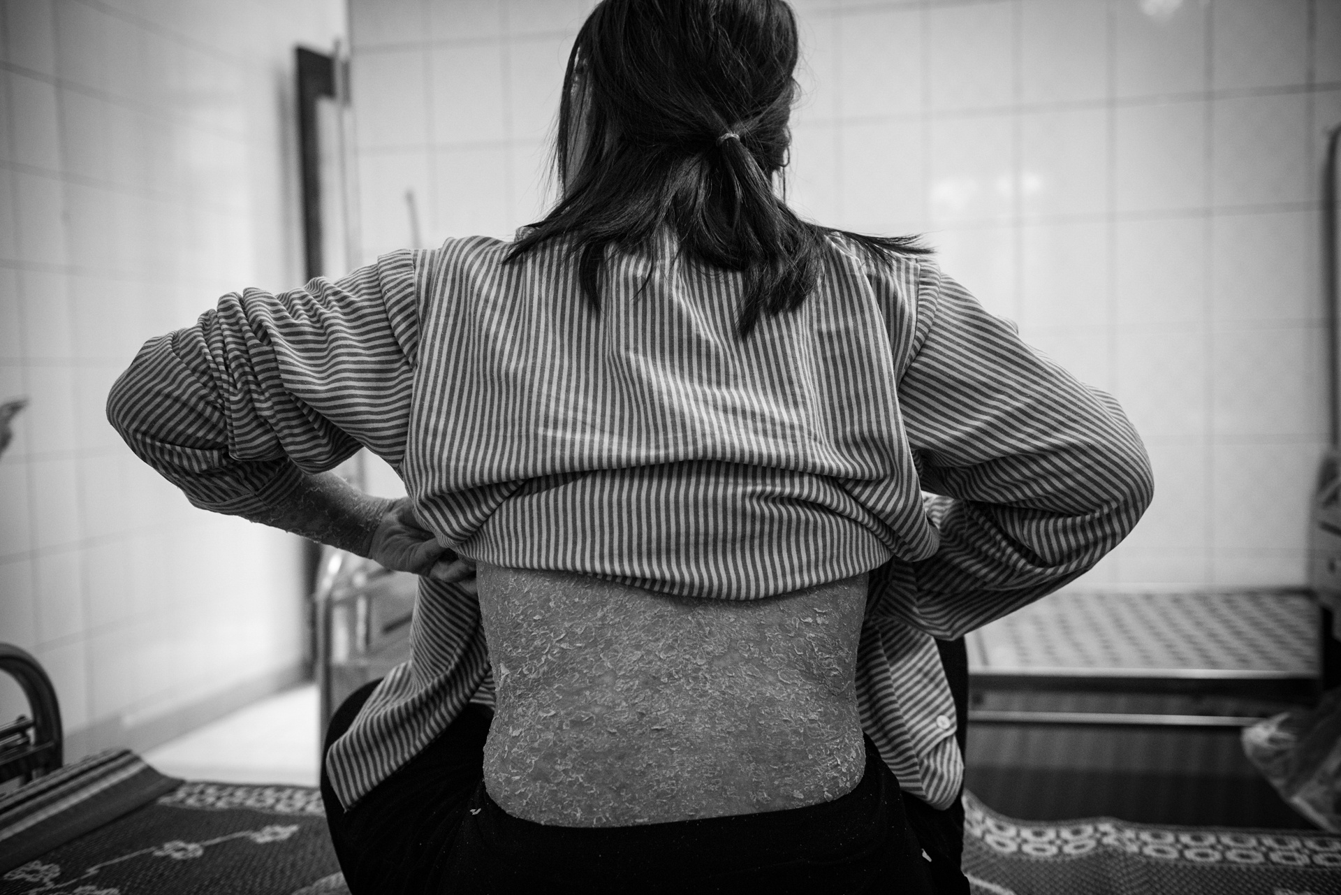 Bệnh nhân vảy nến ảnh 17 Benh nhan vay nen anh 17