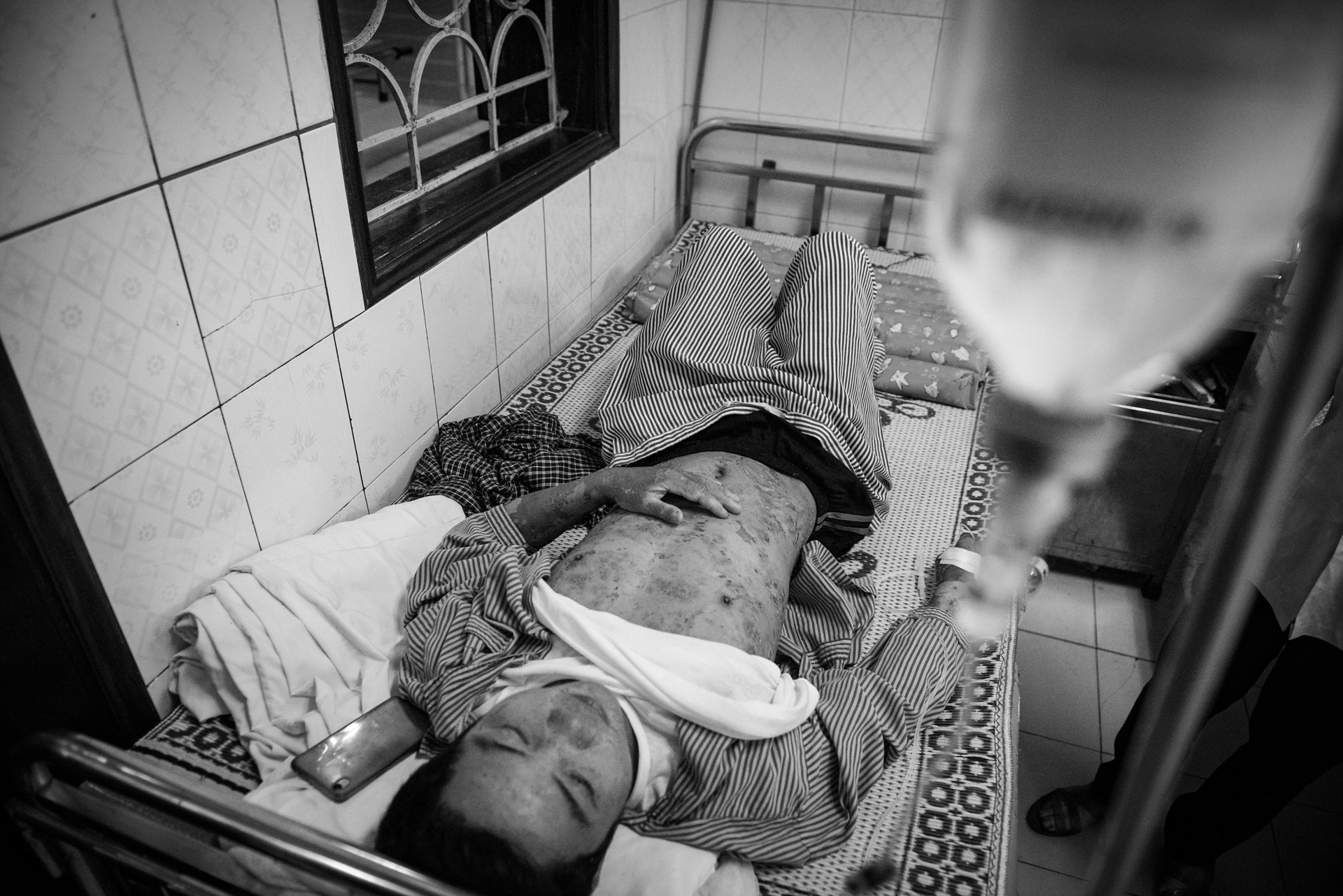 Bệnh nhân vảy nến ảnh 22 Benh nhan vay nen anh 22