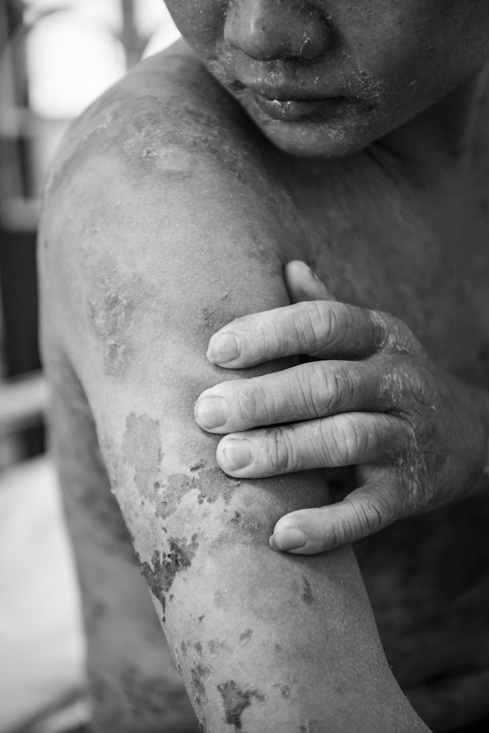 Bệnh nhân vảy nến ảnh 10 Benh nhan vay nen anh 10