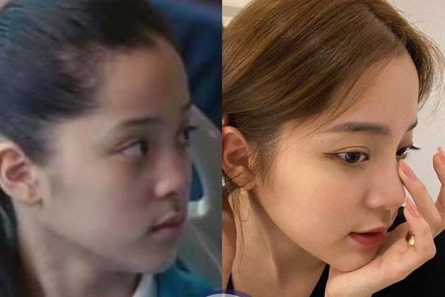 Au Duong Na Na bi nghi phau thuat tham my hinh anh