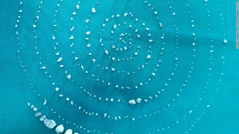 Bé trai Ấn Độ có 526 chiếc răng trong miệng ảnh 1 Be trai An Do co 526 chiec rang trong mieng anh 1