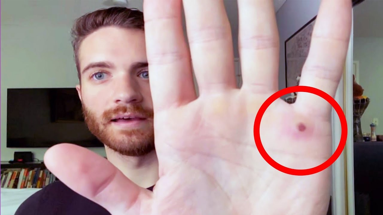 Nam dien vien My ke lai qua trinh mac benh dau mua khi hinh anh