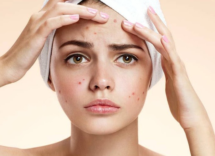 Vi sao khong nen nan mun trung ca? hinh anh