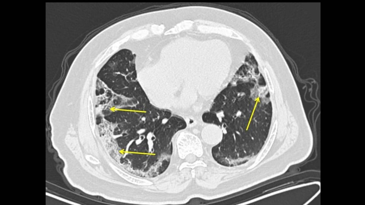 Chot tu than cua virus corona hinh anh