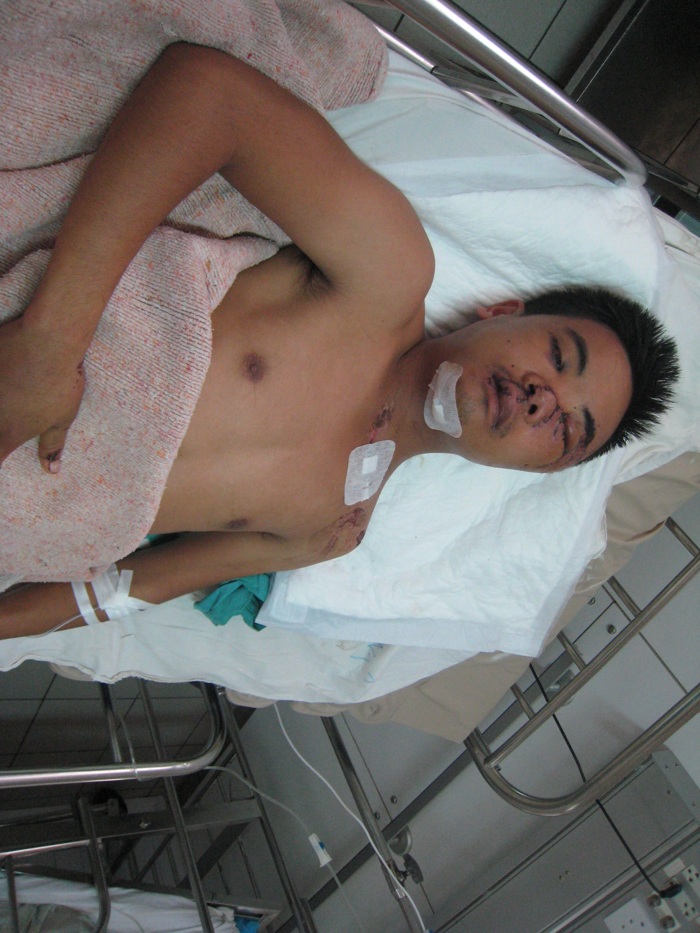 Cuu song thanh nien bi tai nan dap nat khuon mat hinh anh