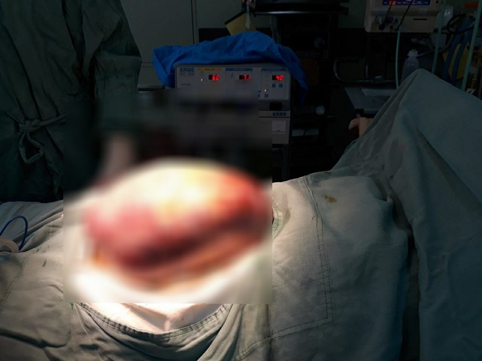 Khối u nặng hơn 5 kg ảnh 1 Khoi u nang hon 5 kg anh 1