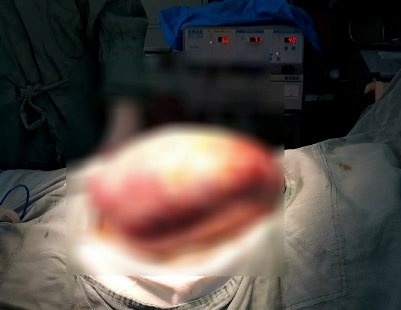 Phau thuat khoi u nang hon 5 kg cuu song nu benh nhan hinh anh