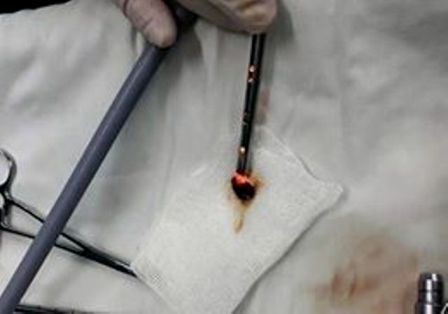 Cuu song benh nhi 7 thang tuoi bi hoc hat dua hinh anh