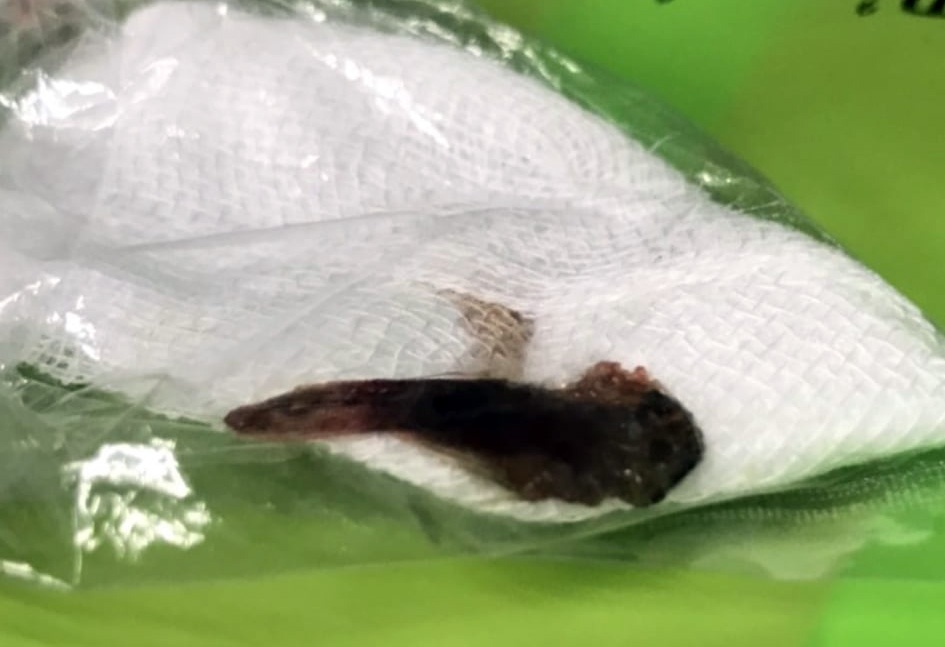 Cá chui vào phổi ảnh 1 Ca chui vao phoi anh 1