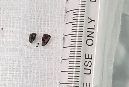 Nam thanh nien bi manh phao ban vao dau dem giao thua hinh anh