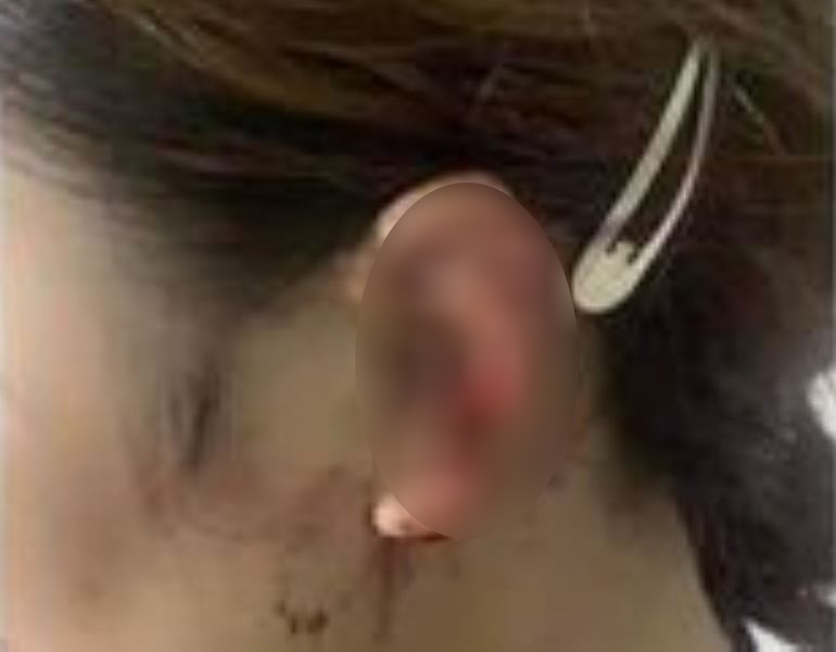 can dut tai tinh dich anh 2