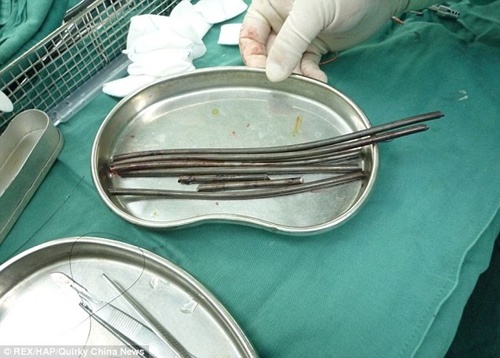 Thoat chet du bi 7 thanh kim loai xuyen trung hong hinh anh