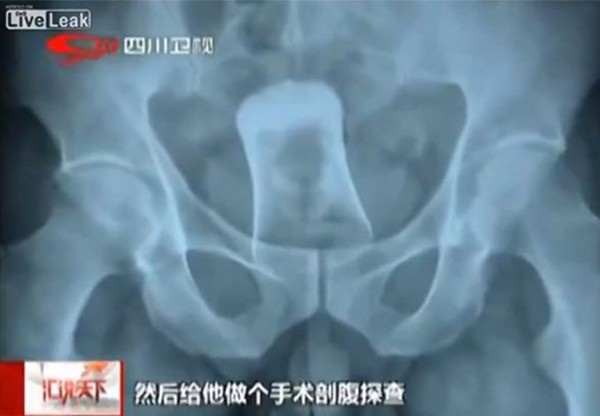 Chiec ly mac ket trong hau mon hinh anh