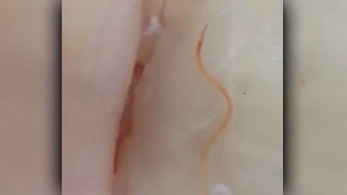 Phat hien giun con song trong ca ban o sieu thi hinh anh