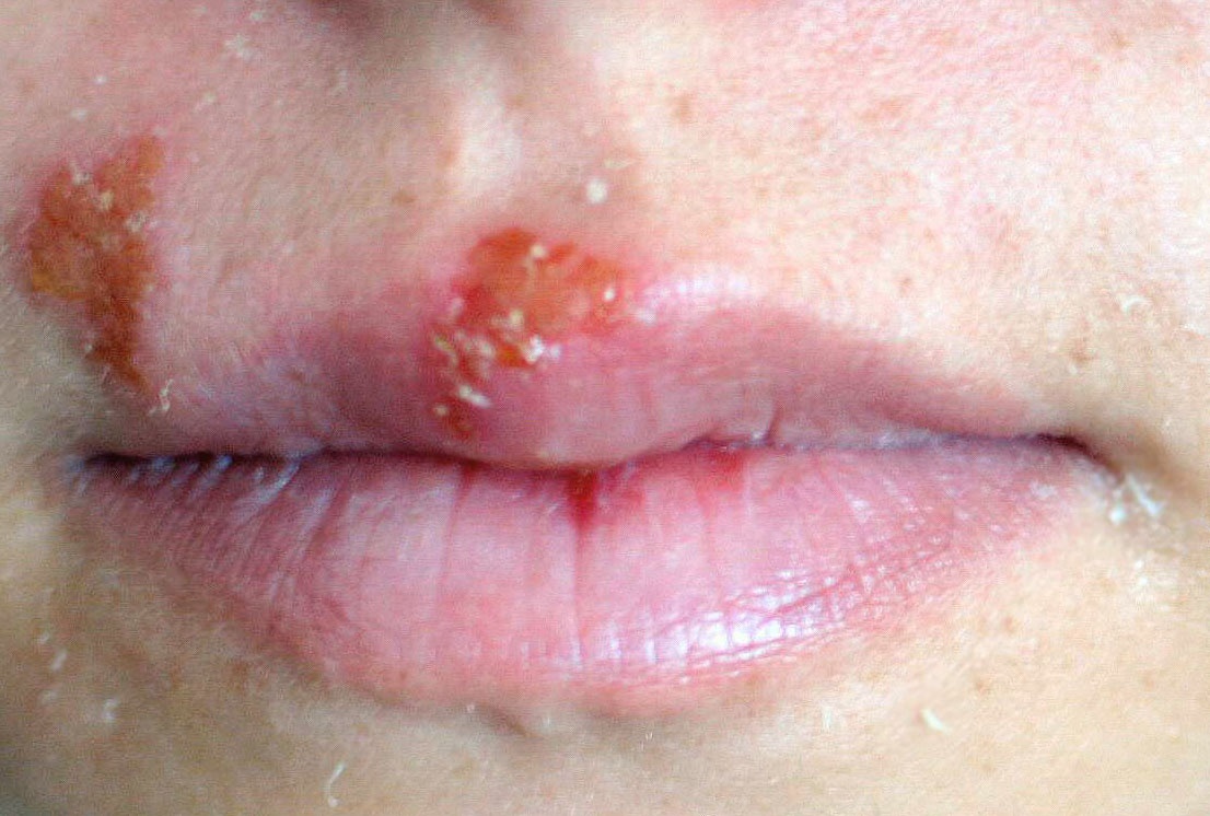 Theo các chuyên gia, son môi là hợp chất tạo màu bao gồm các kim loại chủ yếu là chì, mangan, propylparaben, nhôm, dầu khoáng,… nên có thể gây ra hiện tượng bỏng rát, phồng rộp, mất nước ở môi; dùng nhiều có thể dẫn tới nguy cơ ung thư.