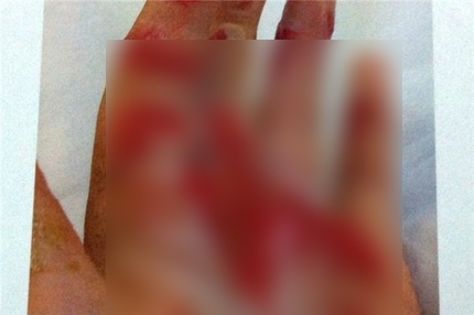 Sử dụng đá khô không đúng cách có thể gây bỏng tay.