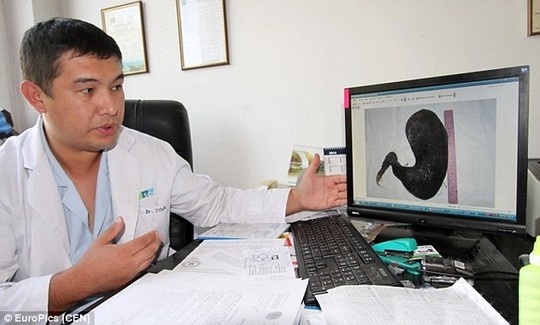 Búi tóc hơn 4 kg được lấy ra từ dạ dày thiếu nữ.