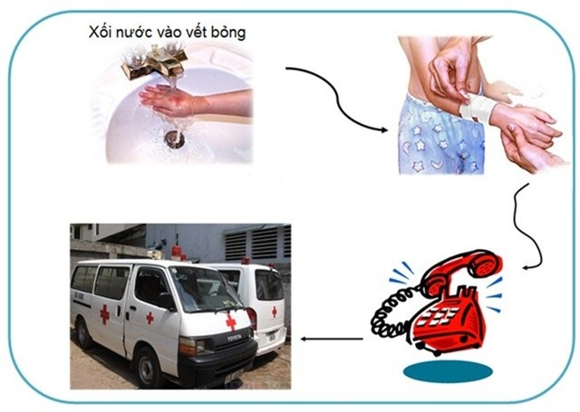 Cach don gian giup con thoat khoi dau don khi bi bong hinh anh