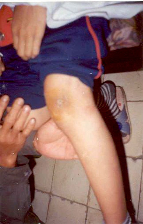 Sán chui ra từ khớp gối - Ảnh: GS.TS Nguyễn Văn Đề cung cấp.