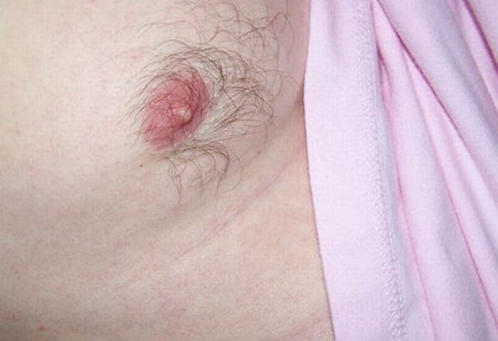 2. Ung thư vú: Các chuyên gia khuyến cáo giới mày râu nên cẩn trọng khi phát hiện những khối u hay da đổi màu bất thường tại ngực.