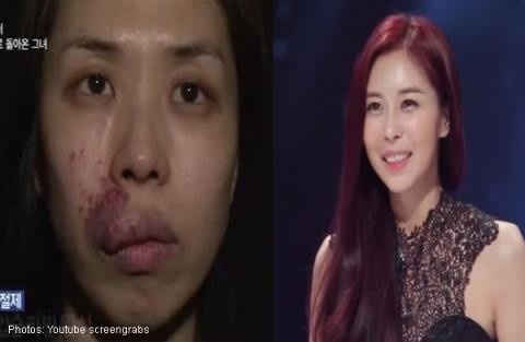 Kim Hee-Eun trước và sau phẫu thuật