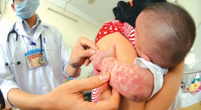 Phat hien o dich sot phat ban nghi soi tai Nghe An hinh anh