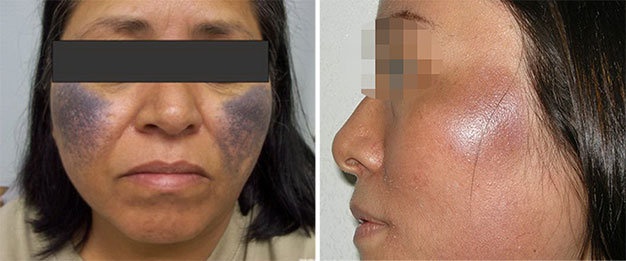 Các trường hợp bị rối loạn sau điều trị nám.